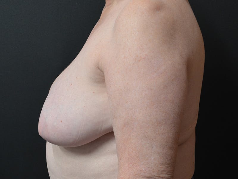 Breast Reconstruction Before & After Gallery - Patient 978215 - Image 5