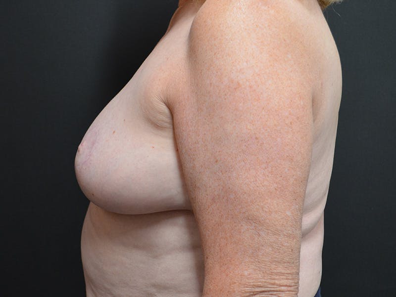 Breast Reconstruction Before & After Gallery - Patient 978215 - Image 6