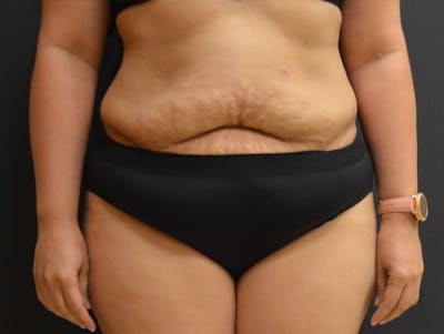 Tummy Tuck Before & After Gallery - Patient 919535 - Image 1