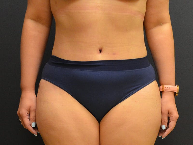 Tummy Tuck Before & After Gallery - Patient 919535 - Image 2