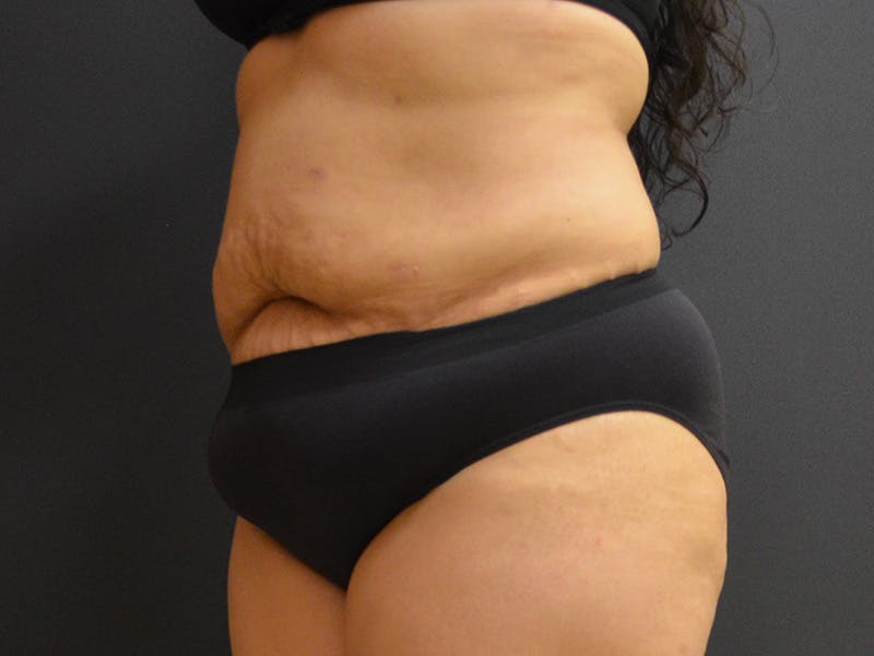 Tummy Tuck Before & After Gallery - Patient 919535 - Image 3