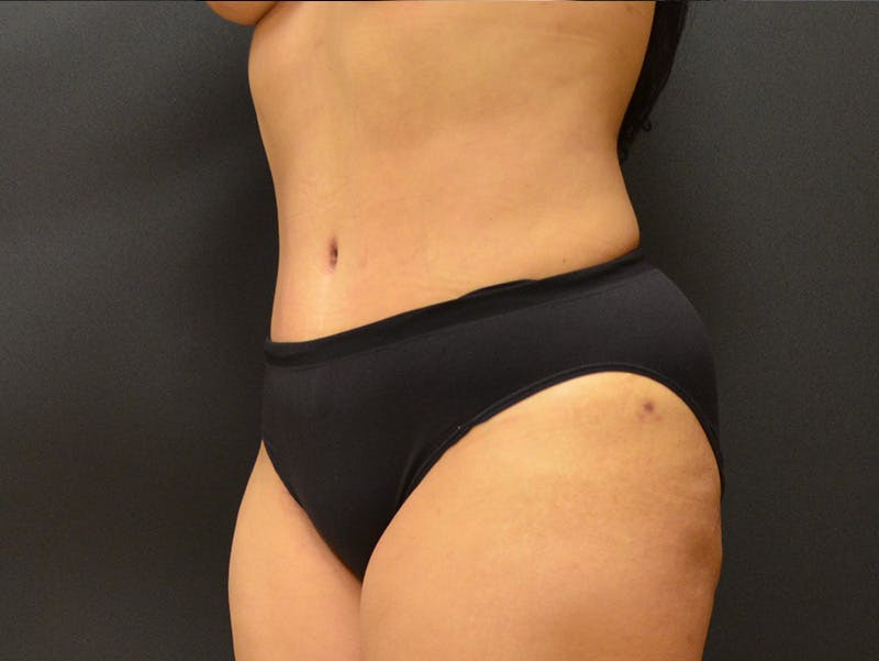 Tummy Tuck Before & After Gallery - Patient 919535 - Image 4