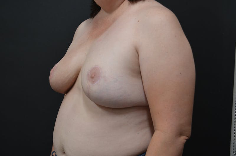 Breast Reconstruction Before & After Gallery - Patient 134324 - Image 4