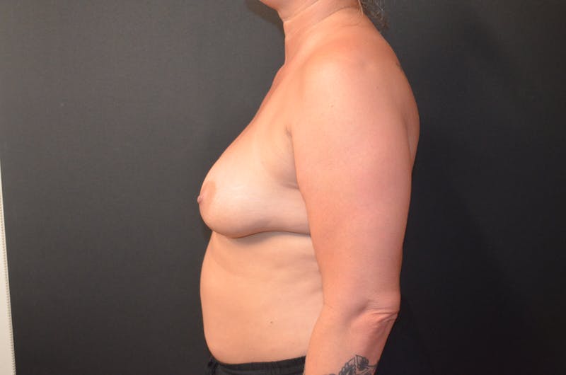 Breast Reconstruction Before & After Gallery - Patient 517013 - Image 4