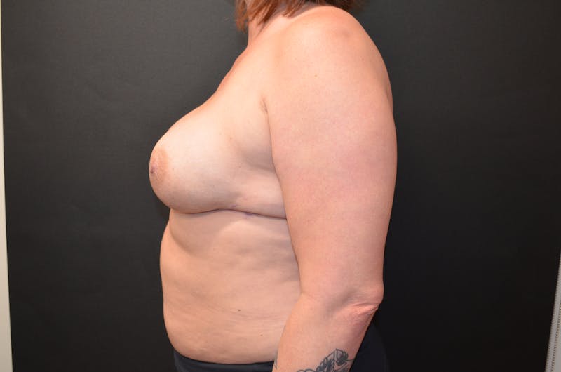 Breast Reconstruction Before & After Gallery - Patient 517013 - Image 3