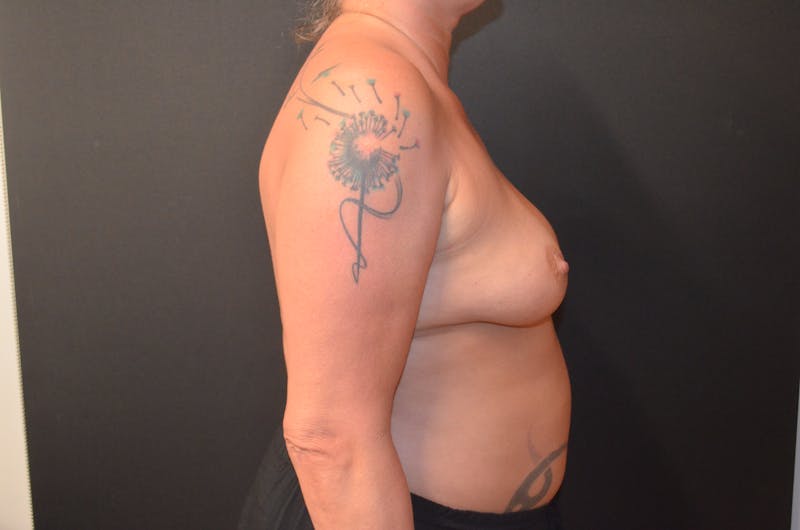 Breast Reconstruction Before & After Gallery - Patient 517013 - Image 5