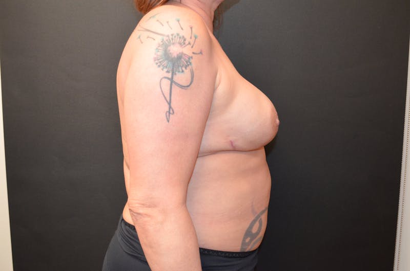 Breast Reconstruction Before & After Gallery - Patient 517013 - Image 6