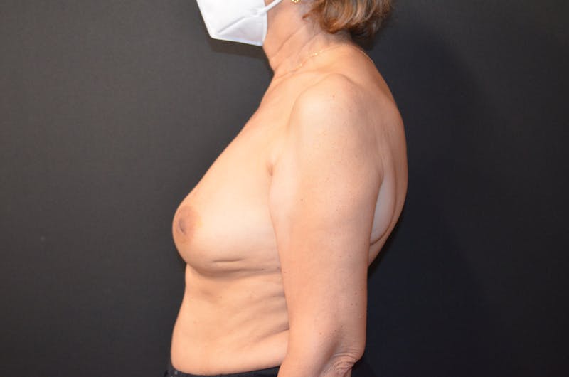 Breast Implant Reconstruction Before & After Gallery - Patient 520603 - Image 3