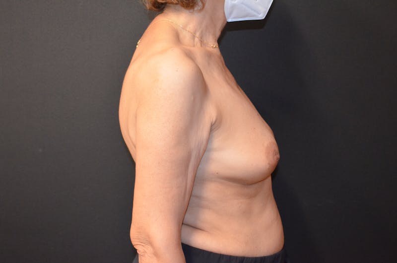 Breast Implant Reconstruction Before & After Gallery - Patient 520603 - Image 5
