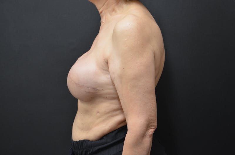 Breast Implant Reconstruction Before & After Gallery - Patient 520603 - Image 4