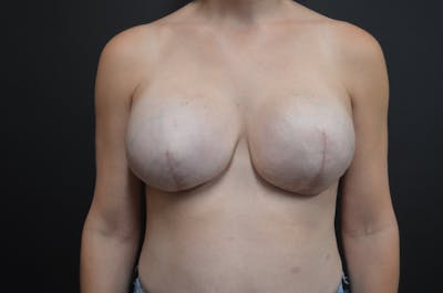Breast Implant Reconstruction Before & After Gallery - Patient 391200 - Image 2