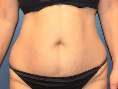 Tummy Tuck Before & After Gallery - Patient 307315 - Image 1