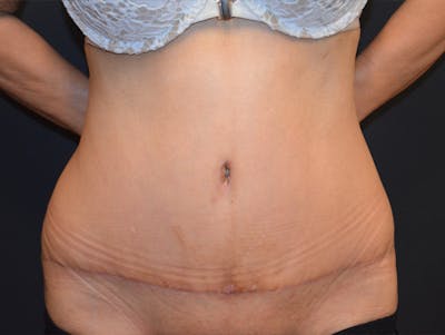 Tummy Tuck Before & After Gallery - Patient 307315 - Image 2