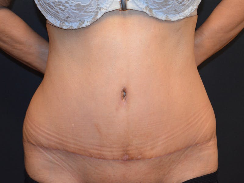 Tummy Tuck Before & After Gallery - Patient 307315 - Image 2
