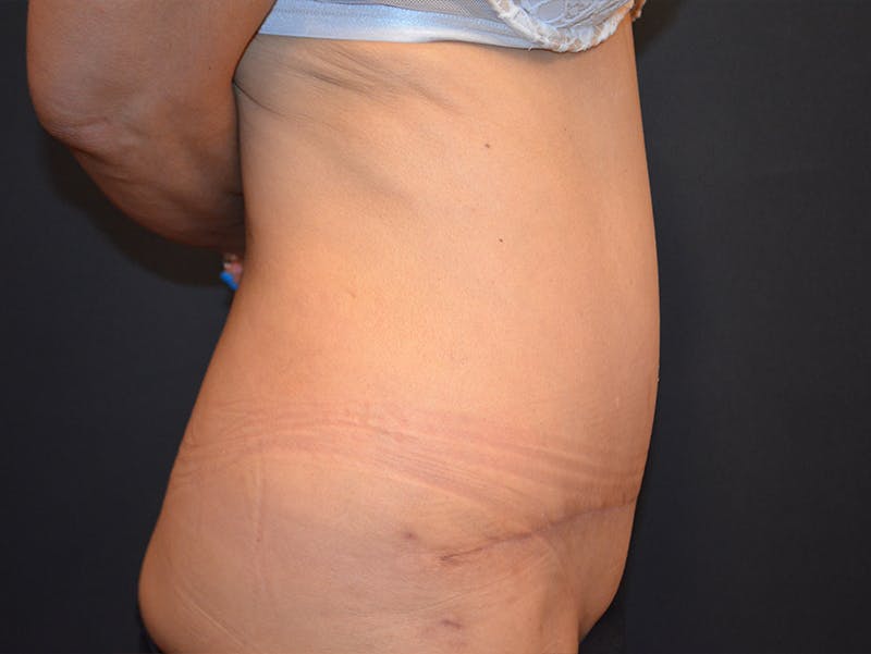 Tummy Tuck Before & After Gallery - Patient 307315 - Image 4