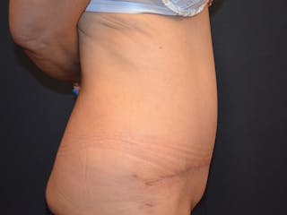 Tummy Tuck Before & After Gallery - Patient 307315 - Image 4
