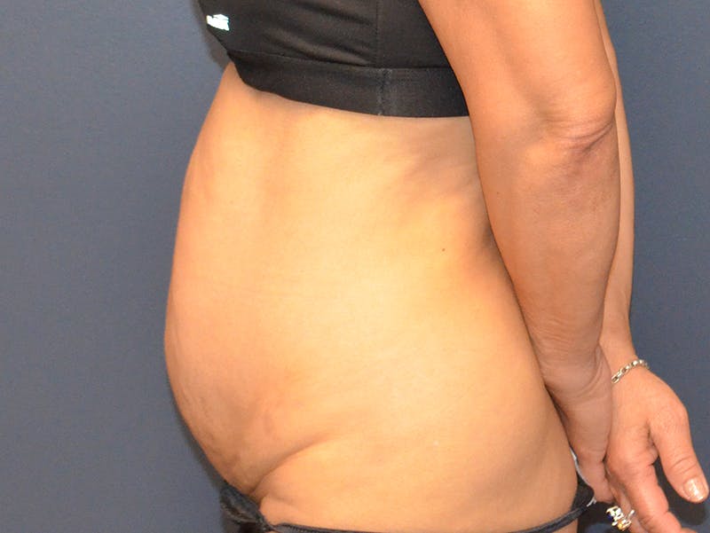 Tummy Tuck Before & After Gallery - Patient 307315 - Image 5