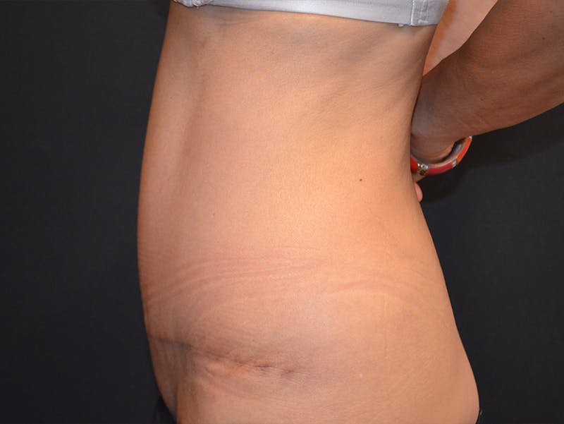 Tummy Tuck Before & After Gallery - Patient 307315 - Image 6