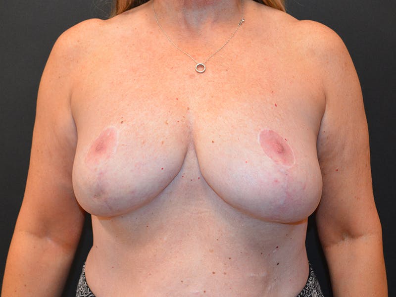 Breast Reduction Before & After Gallery - Patient 223314 - Image 2