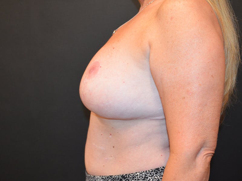 Breast Reduction Before & After Gallery - Patient 223314 - Image 6