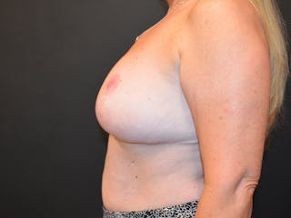Breast Reduction Before & After Gallery - Patient 223314 - Image 6