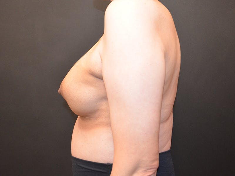 Breast Reconstruction Before & After Gallery - Patient 146830 - Image 5