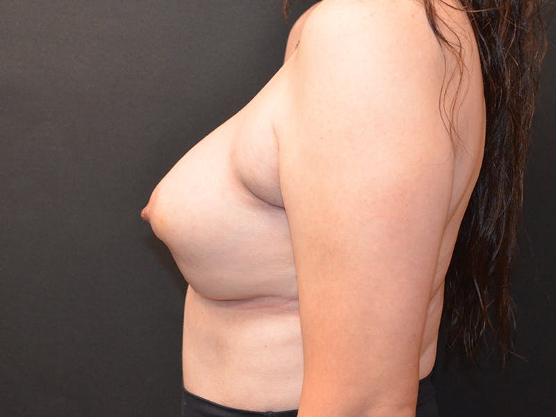 Breast Reconstruction Before & After Gallery - Patient 146830 - Image 6