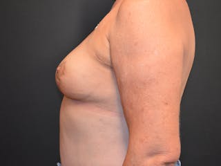 Breast Reconstruction Before & After Gallery - Patient 359821 - Image 4