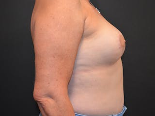 Breast Reconstruction Before & After Gallery - Patient 359821 - Image 6