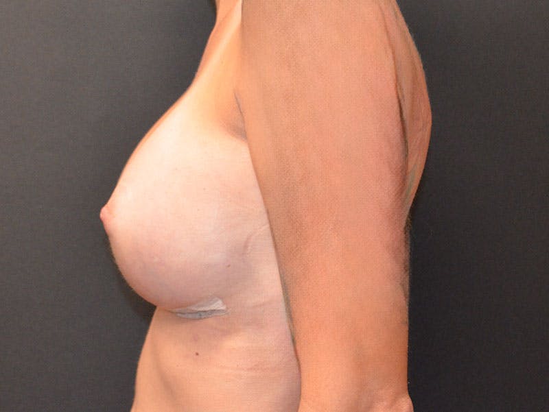 Breast Augmentation Before & After Gallery - Patient 823870 - Image 4