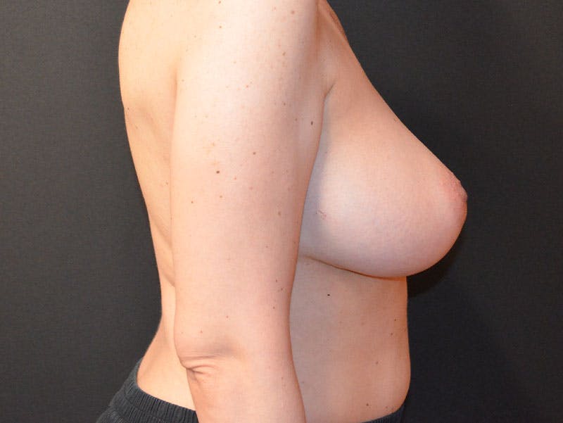 En Bloc Capsulectomy Before & After Gallery - Patient 381248 - Image 5