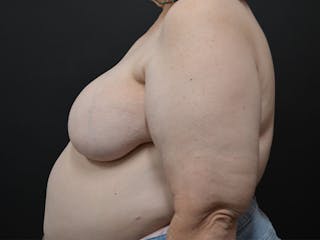 Breast Asymmetry Correction Before & After Gallery - Patient 292041 - Image 4