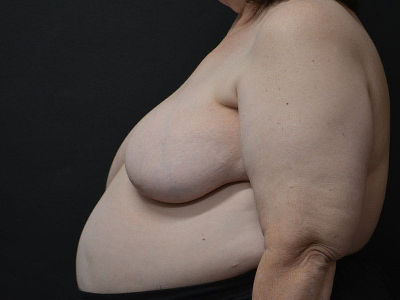 Breast Asymmetry Correction Before & After Gallery - Patient 292041 - Image 3