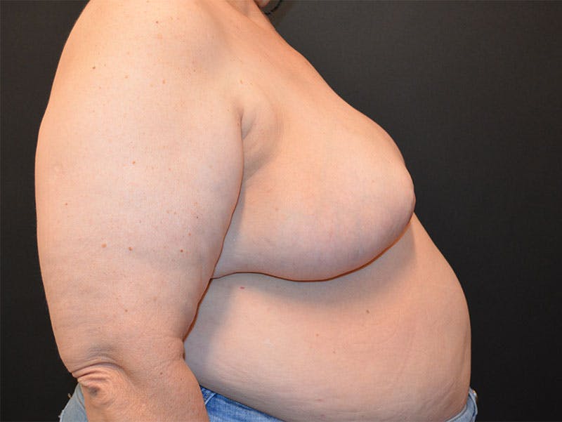 Breast Asymmetry Correction Before & After Gallery - Patient 292041 - Image 6