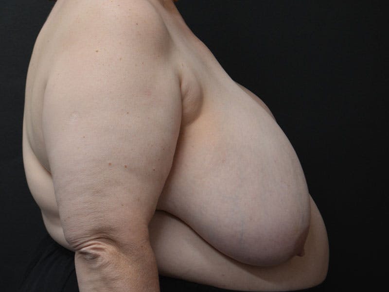 Breast Asymmetry Correction Before & After Gallery - Patient 292041 - Image 5