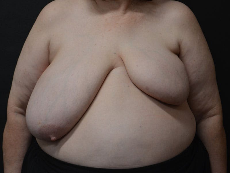 Breast Asymmetry Correction Before & After Gallery - Patient 292041 - Image 1