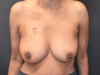 Breast Implant Reconstruction Before & After Gallery - Patient 249950 - Image 2