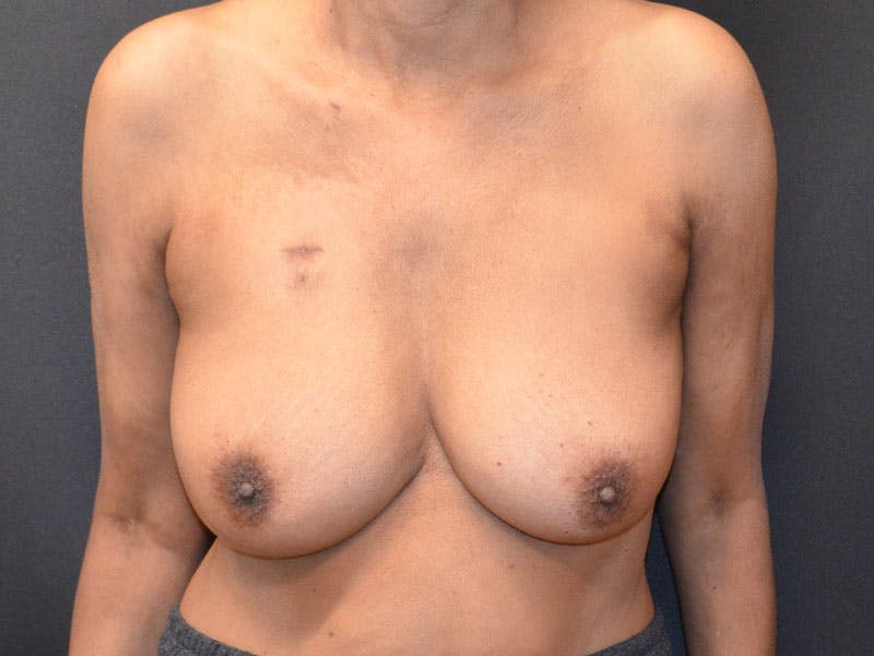 Breast Implant Reconstruction Before & After Gallery - Patient 249950 - Image 2