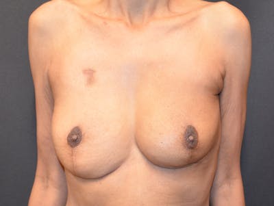 Breast Implant Reconstruction Before & After Gallery - Patient 249950 - Image 1