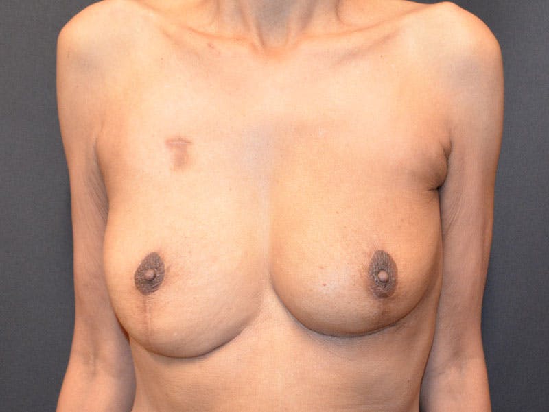 Breast Implant Reconstruction Before & After Gallery - Patient 249950 - Image 1