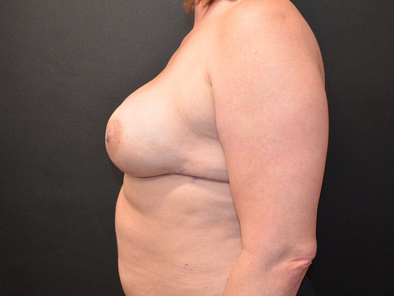 Breast Implant Reconstruction Before & After Gallery - Patient 360402 - Image 4