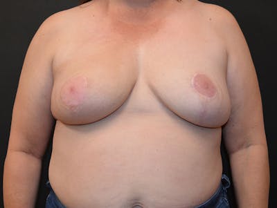 Breast Implant Reconstruction Before & After Gallery - Patient 544438 - Image 2