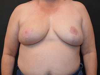 Breast Implant Reconstruction Before & After Gallery - Patient 544438 - Image 2