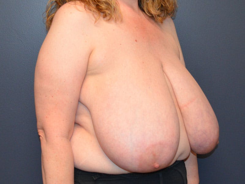 Breast Reconstruction Before & After Gallery - Patient 138932 - Image 5