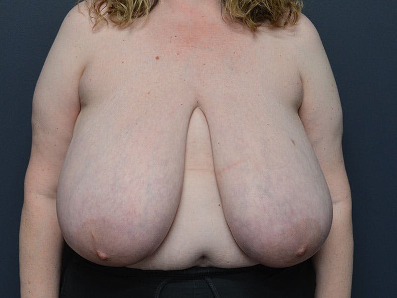 Breast Reconstruction Before & After Gallery - Patient 138932 - Image 1