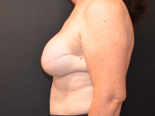 Breast Reconstruction Before & After Gallery - Patient 198761 - Image 6