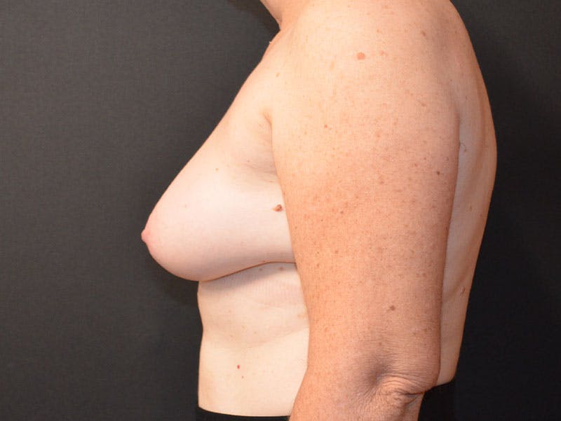 Breast Reconstruction Before & After Gallery - Patient 198761 - Image 5