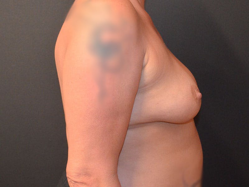 Breast Reconstruction Before & After Gallery - Patient 517013 - Image 5