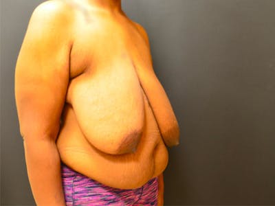 Breast Implant Reconstruction Before & After Gallery - Patient 167373888 - Image 1