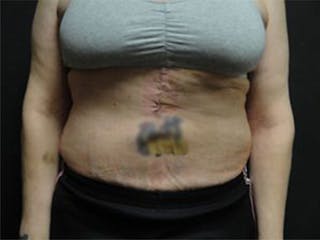 Body Reconstruction Before & After Gallery - Patient 167358386 - Image 2